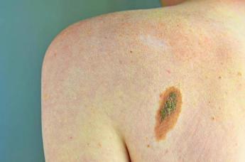 Imi: "Bene legge su prevenzione melanoma, educare i giovani su rischi"