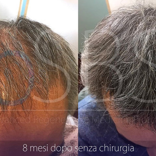 Alopecia, le potenzialità della Rigenerazione Cellulare Alopecia, le potenzialità della Rigenerazione Cellulare