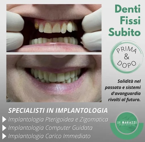 Presso lo Studio Dentistico Marazzi a Sanremo, implantologia computer assistita senza dolore Presso lo Studio Dentistico Marazzi a Sanremo, implantologia computer assistita senza dolore