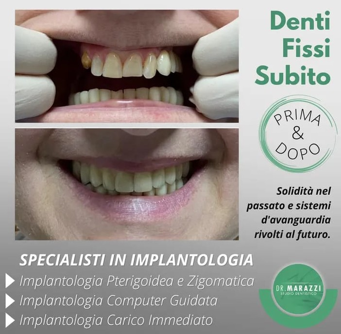 Presso lo Studio Dentistico Marazzi a Sanremo, implantologia computer assistita senza dolore Presso lo Studio Dentistico Marazzi a Sanremo, implantologia computer assistita senza dolore