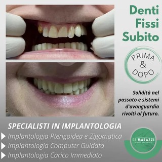 Presso lo Studio Dentistico Marazzi a Sanremo, implantologia computer assistita senza dolore Presso lo Studio Dentistico Marazzi a Sanremo, implantologia computer assistita senza dolore