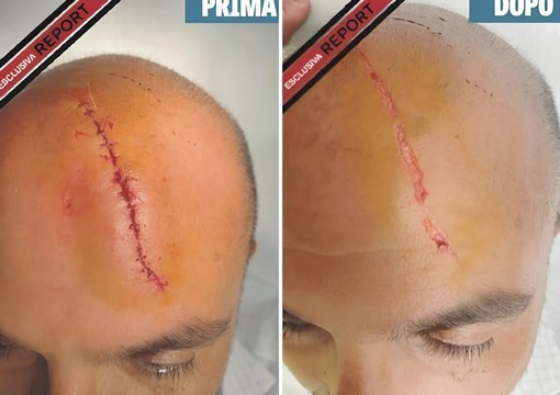 La trasmissione di Rai Tre 'Report' torna sul caso Sangiuliano-Boccia: la ferita alla testa venne provocata a Sanremo La trasmissione di Rai Tre 'Report' torna sul caso Sangiuliano-Boccia: la ferita alla testa venne provocata a Sanremo