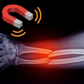 Riabilitazione post frattura: come la magnetoterapia accelera la guarigione