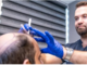Chi esegue davvero il vostro trapianto di capelli: un medico o un tecnico? Chi esegue davvero il vostro trapianto di capelli: un medico o un tecnico?