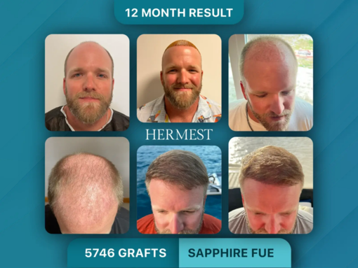 Trapianto di capelli in Turchia: perché sempre più italiani scelgono cliniche dottore-guidate per un risultato naturale Trapianto di capelli in Turchia: perché sempre più italiani scelgono cliniche dottore-guidate per un risultato naturale