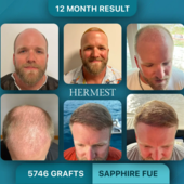 Trapianto di capelli in Turchia: perché sempre più italiani scelgono cliniche dottore-guidate per un risultato naturale Trapianto di capelli in Turchia: perché sempre più italiani scelgono cliniche dottore-guidate per un risultato naturale