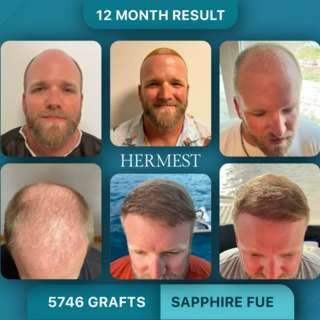 Trapianto di capelli in Turchia: perché sempre più italiani scelgono cliniche dottore-guidate per un risultato naturale Trapianto di capelli in Turchia: perché sempre più italiani scelgono cliniche dottore-guidate per un risultato naturale