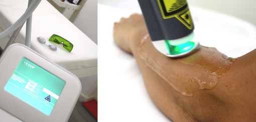 A Sanremo arriva “Venus”, la nuova era dell'Epilazione Laser definitiva: in esclusiva da NAPA Estetica Avanzata A Sanremo arriva “Venus”, la nuova era dell'Epilazione Laser definitiva: in esclusiva da NAPA Estetica Avanzata