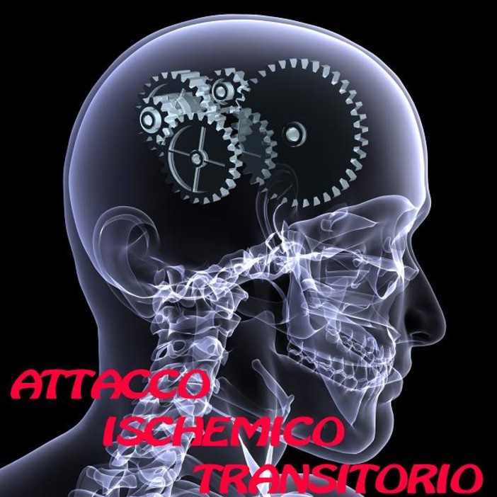 Attacco ischemico transitorio (TIA) Attacco ischemico transitorio (TIA)