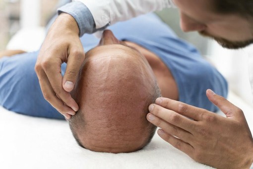 Cliniche di trapianto di capelli in Turchia: guida completa (2026) Cliniche di trapianto di capelli in Turchia: guida completa (2026)