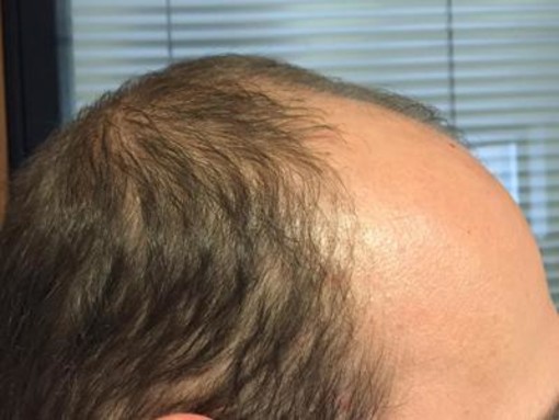 Ti mancano i tuoi capelli? Scegli: tricopigmentazione permanente o temporanea Ti mancano i tuoi capelli? Scegli: tricopigmentazione permanente o temporanea