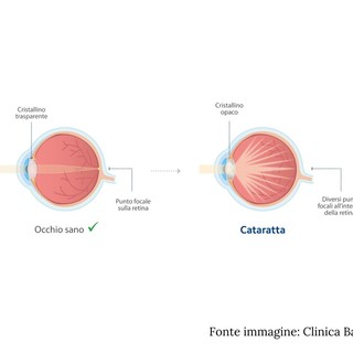 Cosa aspettarsi durante la prima visita per valutare l'intervento di cataratta?