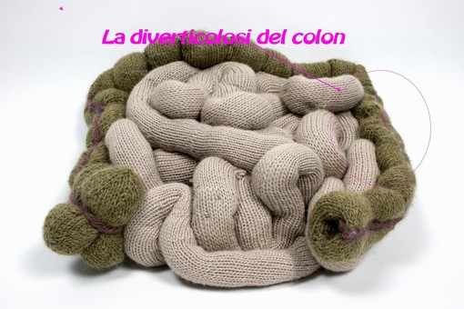 Salute & Benessere: la diverticolosi del colon Salute & Benessere: la diverticolosi del colon