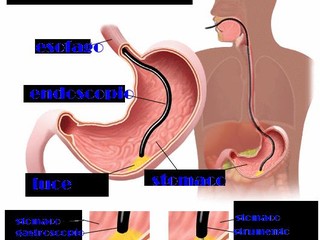 Esempio di gastroscopia Esempio di gastroscopia