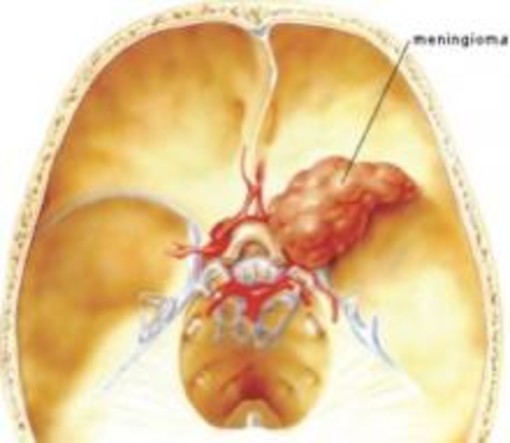 Il Dott. Marco Mannino, autore della rubrica Dica 33, questa volta ci parla di meningioma Il Dott. Marco Mannino, autore della rubrica Dica 33, questa volta ci parla di meningioma