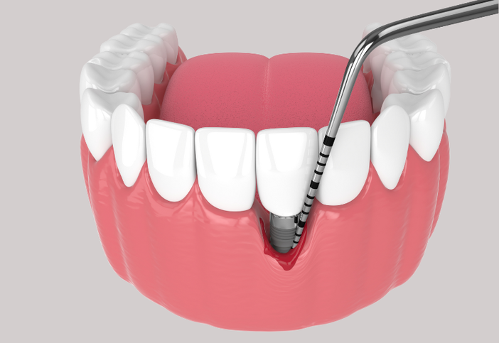 La perimplantite: una minaccia emergente nell’odontoiatria moderna La perimplantite: una minaccia emergente nell’odontoiatria moderna