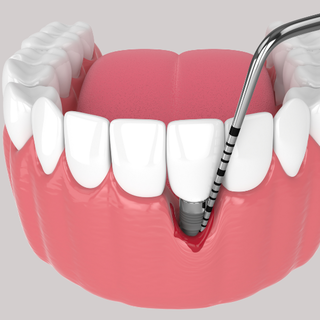 La perimplantite: una minaccia emergente nell’odontoiatria moderna