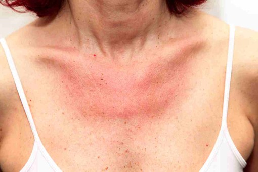 Scottature solari, quali sono i rimedi naturali più efficaci? Scottature solari, quali sono i rimedi naturali più efficaci?