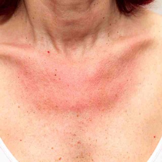 Scottature solari, quali sono i rimedi naturali più efficaci?