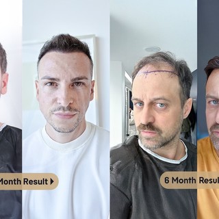 Istanbul Vita: trapianto con tecnica Vita e pianificazione microscopica