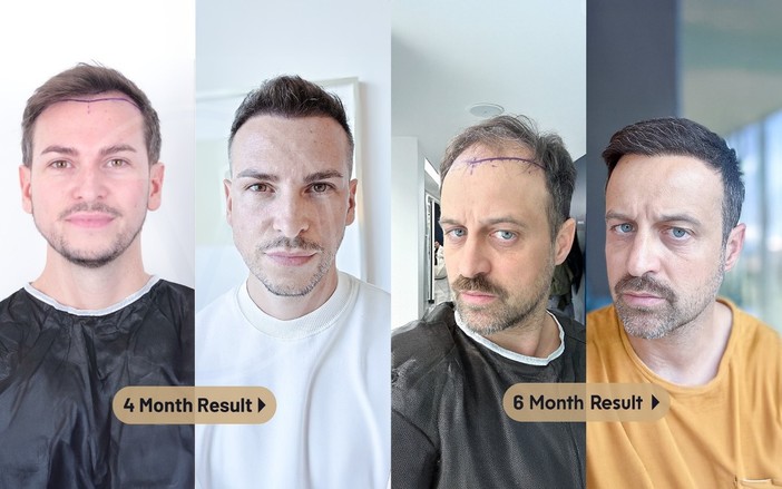 Istanbul Vita: trapianto con tecnica Vita e pianificazione microscopica Istanbul Vita: trapianto con tecnica Vita e pianificazione microscopica