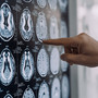 Neurologi: "Per tumori cerebrali la svolta della medicina di precisione"