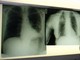 Cancro polmone, con nuova combinazione malattia sotto controllo più a lungo Cancro polmone, con nuova combinazione malattia sotto controllo più a lungo