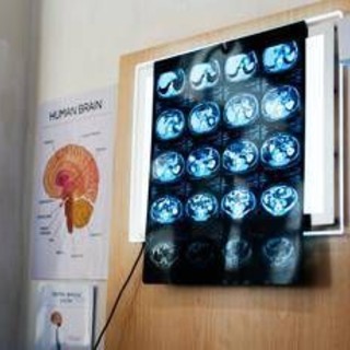 Di Battista, cosa indica un mal di testa forte e improvviso: le ipotesi del neurologo