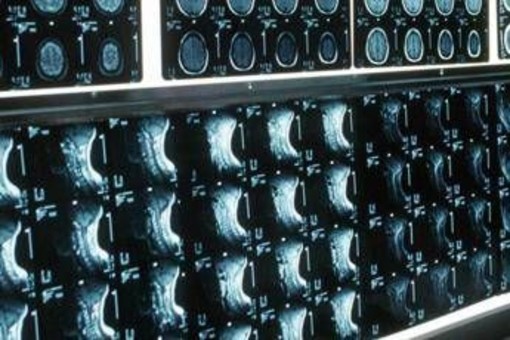 Ipofosfatemia legata all'X, primo bilancio e prospettive su linee guida