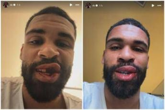 Loftus-Cheek, intervento riuscito alla mascella. E mostra foto dopo scontro in Milan-Parma Loftus-Cheek, intervento riuscito alla mascella. E mostra foto dopo scontro in Milan-Parma