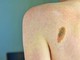 Melanoma, la firma mutazionale del cancro potrà cambiare la cura﻿