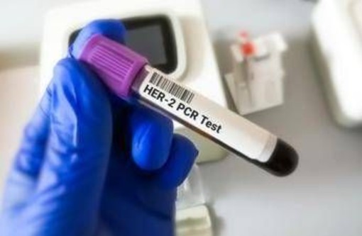 Tumore gastroesofageo Her2+, risultati positivi per tislelizumab con zanidatamab e chemio Tumore gastroesofageo Her2+, risultati positivi per tislelizumab con zanidatamab e chemio