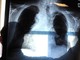 Cancro polmone, nuova terapia orale riduce del 44% il rischio di morte Cancro polmone, nuova terapia orale riduce del 44% il rischio di morte