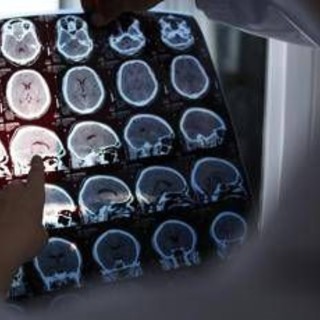 Nuove molecole e bersagli, così si evolve la terapia contro l'Alzheimer: il punto Nuove molecole e bersagli, così si evolve la terapia contro l'Alzheimer: il punto